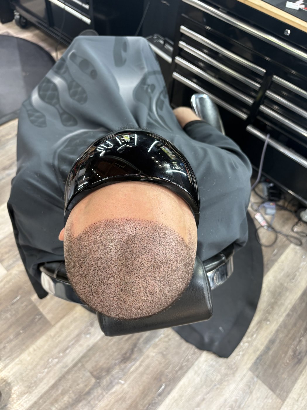 After scalp micropigmentation treatment