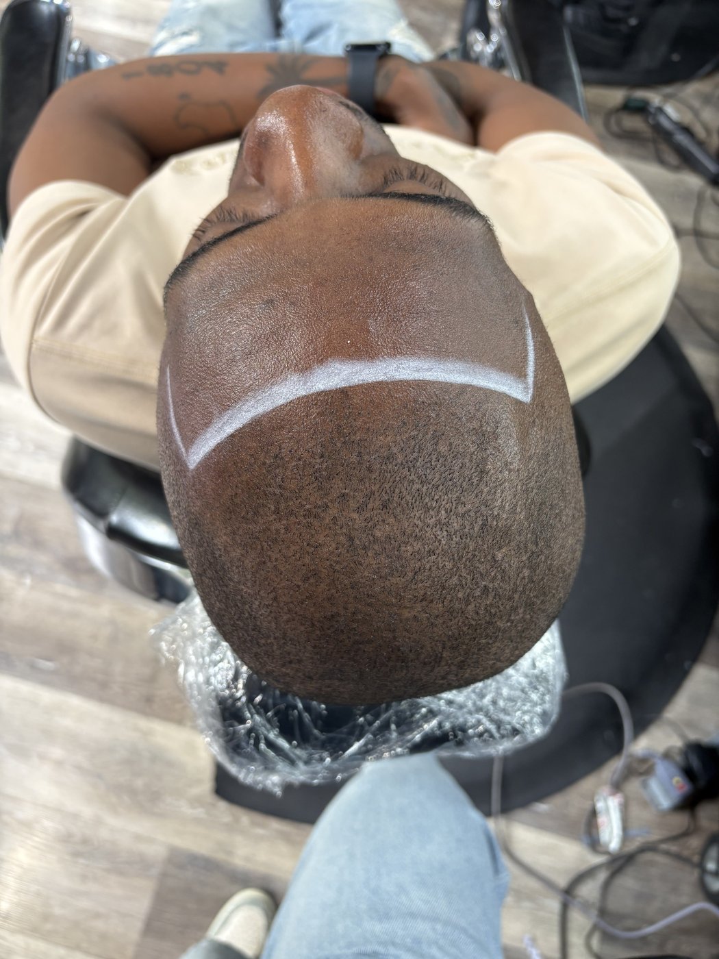 Before scalp micropigmentation treatment
