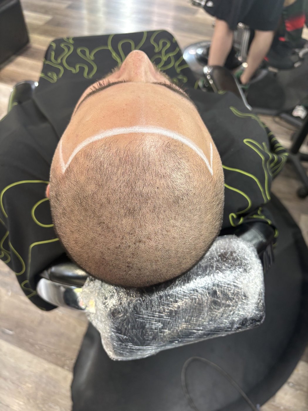 Before scalp micropigmentation treatment