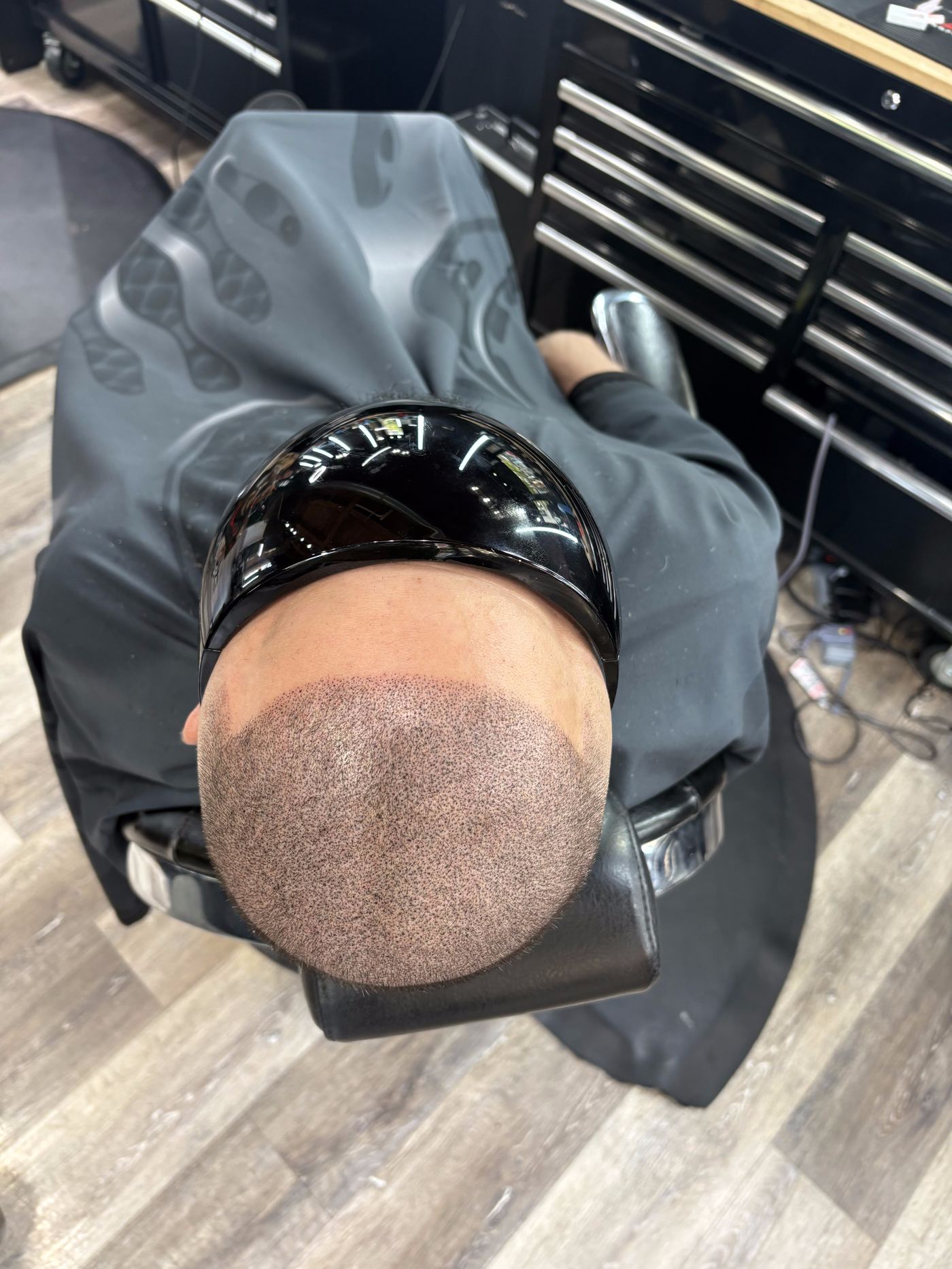 Scalp micropigmentation crown coverage result