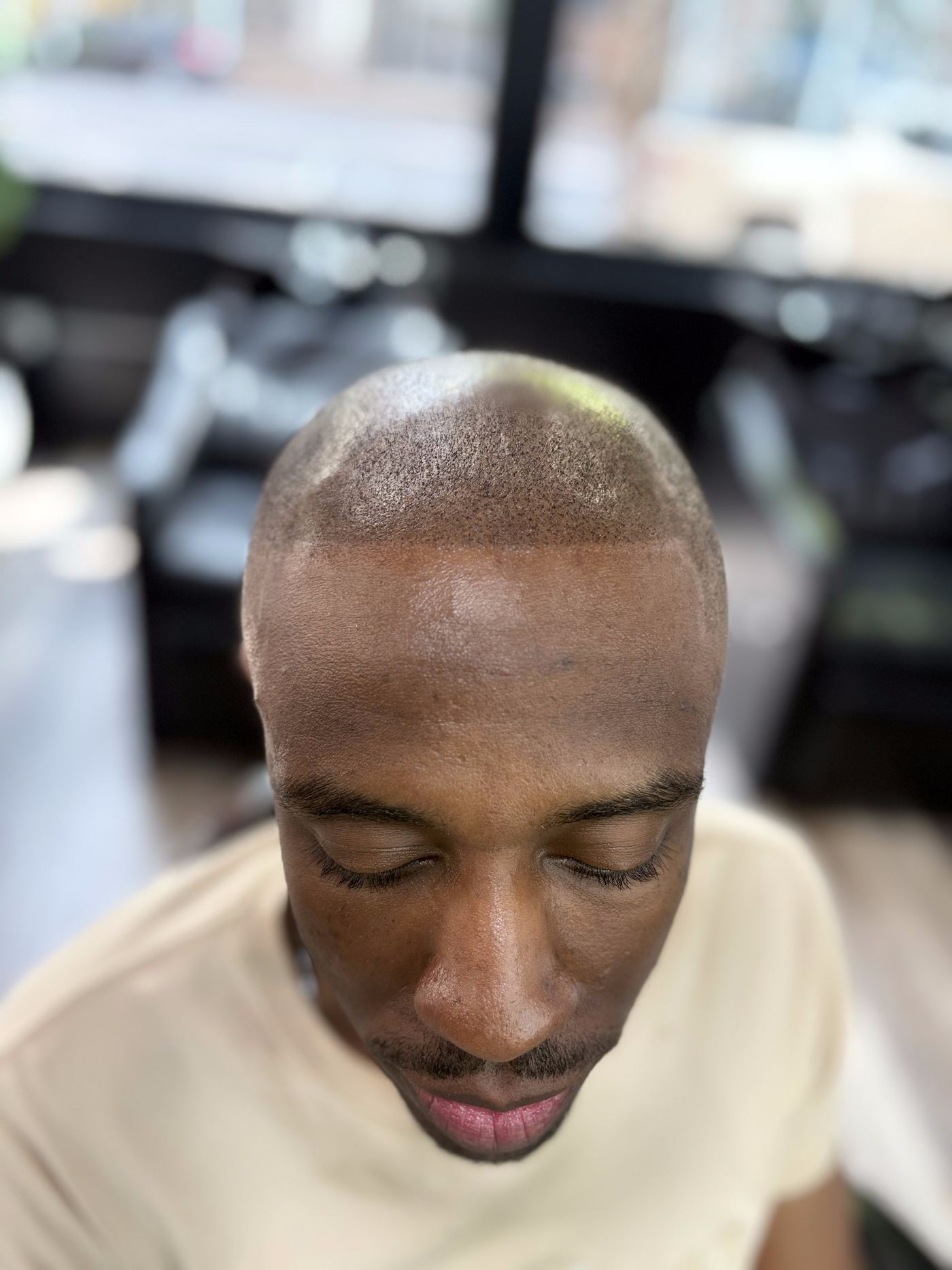 Natural scalp micropigmentation hairline result